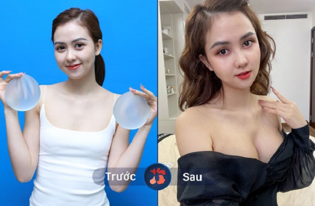 Trước và sau khi nâng ngực
