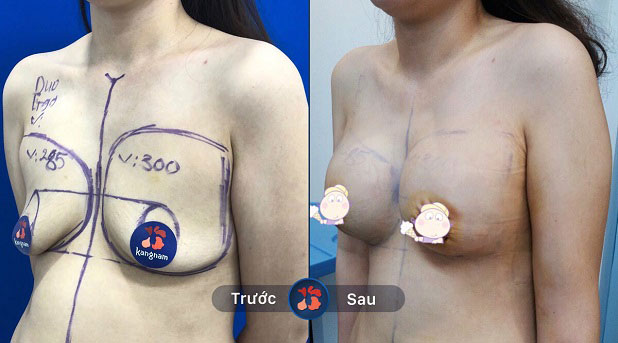 Trước và sau khi khách hàng nâng ngực tại Kangnam