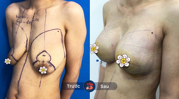 Trước và sau khi khách hàng nâng ngực