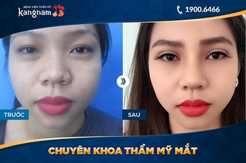 hình ảnh trước và sau khi cắt mí mắt