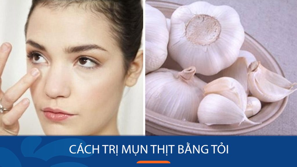 5 Cách trị mụn thịt bằng tỏi Dứt Điểm và Đơn Giản Tại Nhà