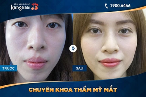 chăm sóc mắt sau khi cắt chỉ