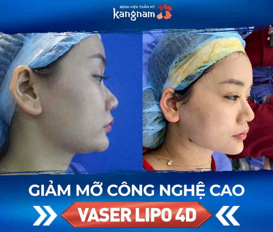 hút mỡ mặt