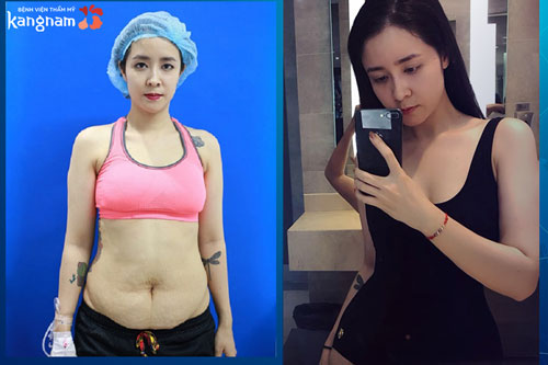 review hút mỡ cánh tay