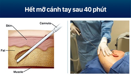 hút mỡ bắp tay viện