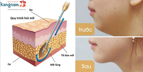 hút mỡ mặt kangnam