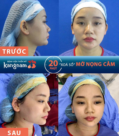 Quá trình thực hiện chỉ trong 20 phút, hạn chế mọi xâm lấn.