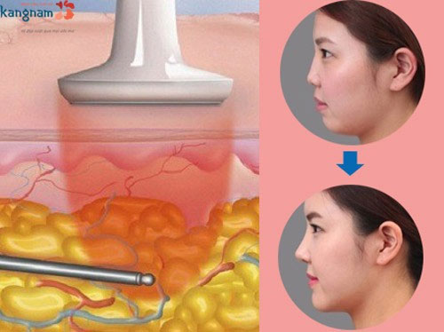 hút mỡ mặt không phẫu thuật
