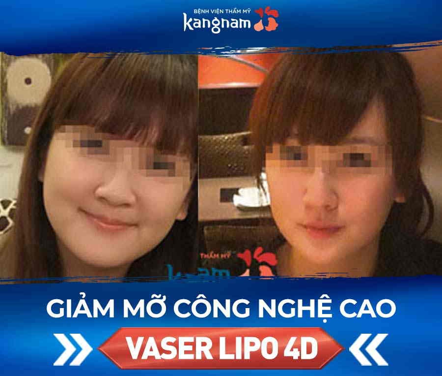 hút mỡ mặt