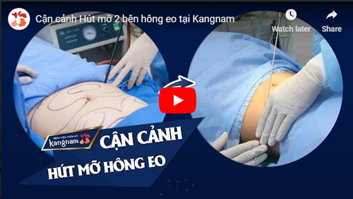 video hút mỡ hông