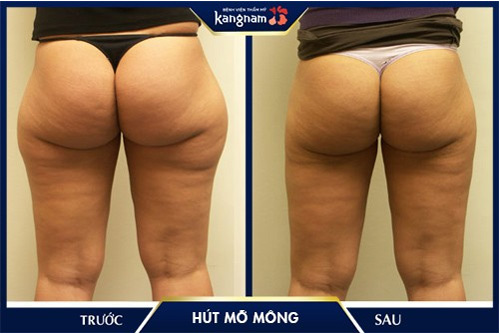 hút mỡ mông ở đâu tốt