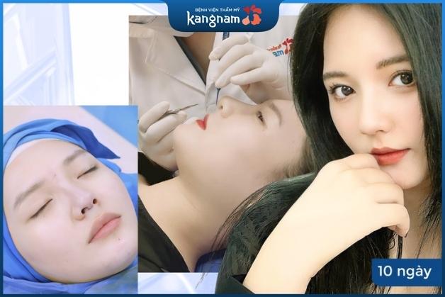 Nâng mũi Kangnam