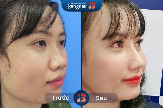 Nâng mũi tại Kangnam hồi phục nhanh sau 2 tuần