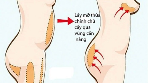 thẩm mỹ vòng 1 bằng mỡ tự thân