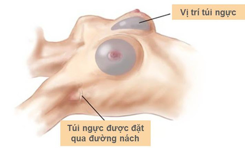 Xem trực tiếp video nâng ngực bằng đường nách Nang-nguc-noi-soi-duong-nach