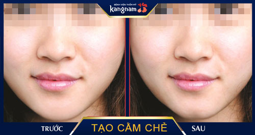 tạo cằm chẻ không phẫu thuật