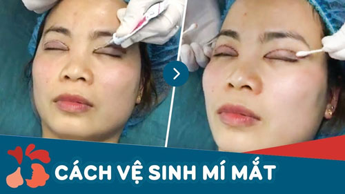 vệ sinh mắt sau khi cắt mí 