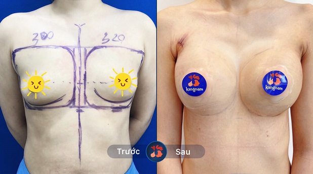 Trước và sau khi nâng ngực 