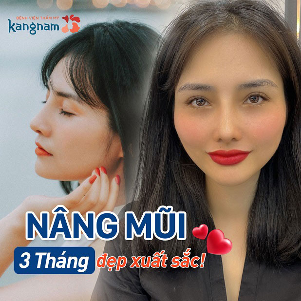 Nâng mũi 3 tháng đẹp xuất sắc