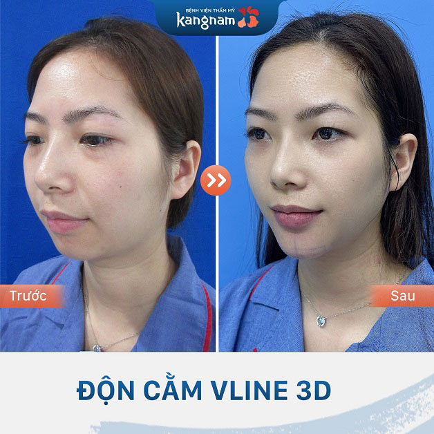 Khách hàng độn cằm VLine 3D tại Kangnam 