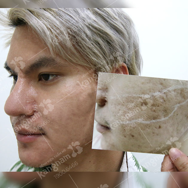 Sẹo lâu năm, thâm trên mặt đã không còn nhìn thấy chỉ sau 1 phác đồ điều trị chuyên sâu tại Kangnam