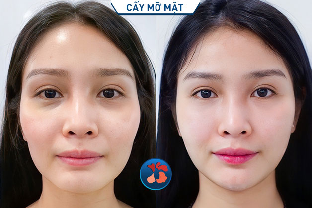 Cấy mỡ Nano Fat tại Kangnam cải thiện toàn diện gương mặt già nua, chảy xệ