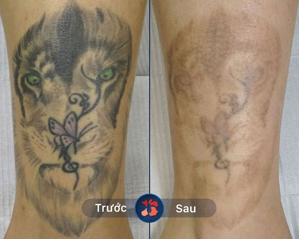 Tattoo đậm màu ở bụng chân hết hoàn toàn sau 4 liệu trình Laser Toning Plus