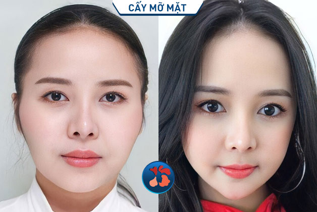 Lấy lại tuổi xuân sau khi thực hiện tiêm mỡ trẻ hóa gương mặt