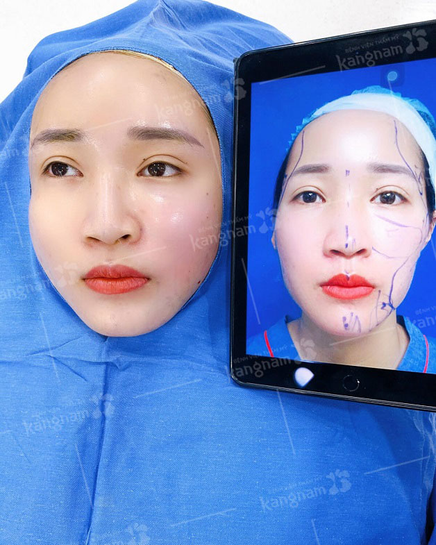 Kết quả đẹp hoàn hảo sau khi cấy mỡ mặt