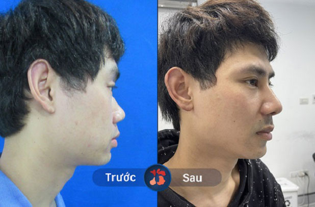 Sụn tai giúp đầu mũi sau nâng thon gọn, cố định Form lâu dài