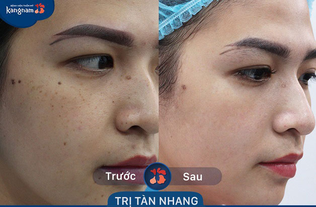 Da trở nên mịn màng và đẹp hơn sau khi tàn nhàng đã được loại bỏ triệt để 