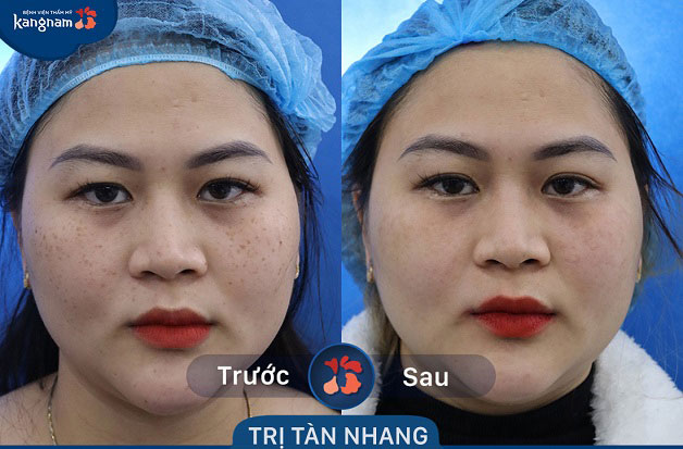 Kết quả trước và sau khác biệt hoàn toàn, làn da đã trở nên mịn màng và xinh hơn 