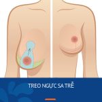 Treo ngực sa trễ – Giải pháp khắc phục tối ưu mọi cấp độ chảy xệ