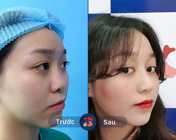 Khách hàng thay đổi sau khi nâng mũi bọc sụn