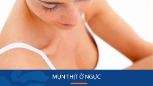 Bí quyết đánh bay mụn thịt ở ngực chỉ trong 7 ngày