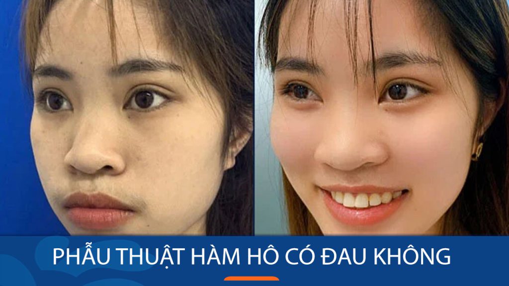 Giảm đau nhanh chóng sau phẫu thuật hàm hô – Tận hưởng quá trình hồi phục nhẹ nhàng
