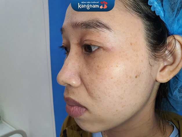 Laser Picosure phù hợp với những người có mảng tàn nhang sâu, lâu năm