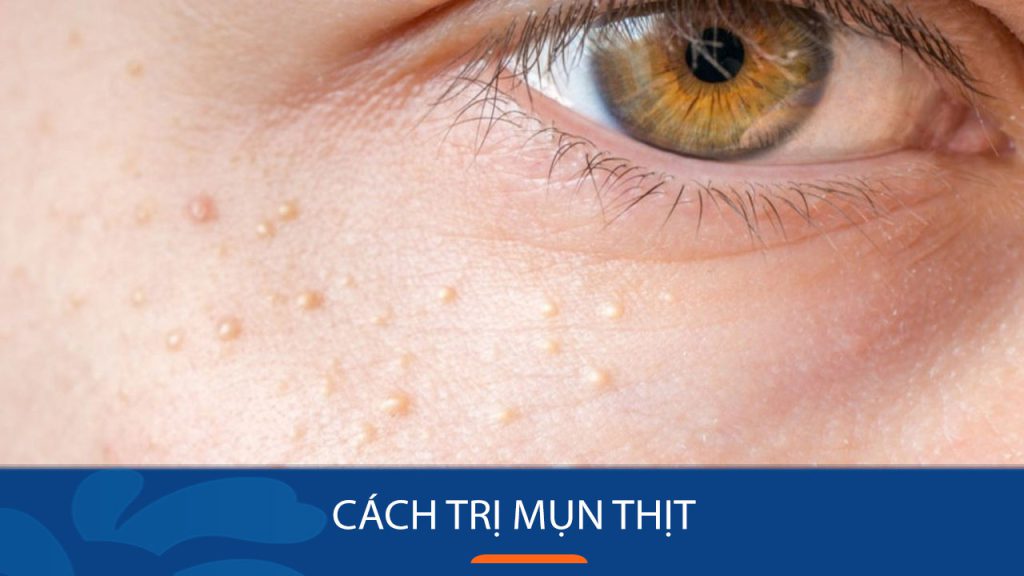 Mụn thịt? Loại bỏ hoàn toàn chỉ trong 7 ngày!