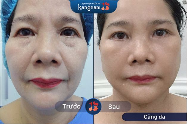 Hình ảnh khách hàng sau khi thực hiện căng da mặt tại Bệnh Viện Kangnam