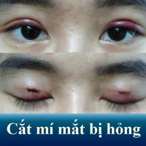 Biểu hiện cắt mí mắt bị hỏng là gì?