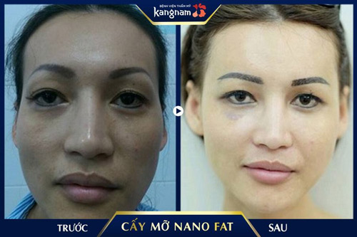 Gương mặt hốc hác, để lộ xương gò má cao sau khi cấy mỡ Nano Fat đã được làm đầy toàn diện, tạo sự cân đối, hài hòa đường nét hơn cấy mỡ mặt