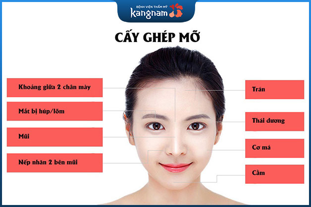Bơm mỡ Nano Fat được áp dụng cho nhiều vùng khác nhau trên gương mặt