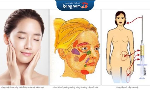 Cấy mỡ Nano fat