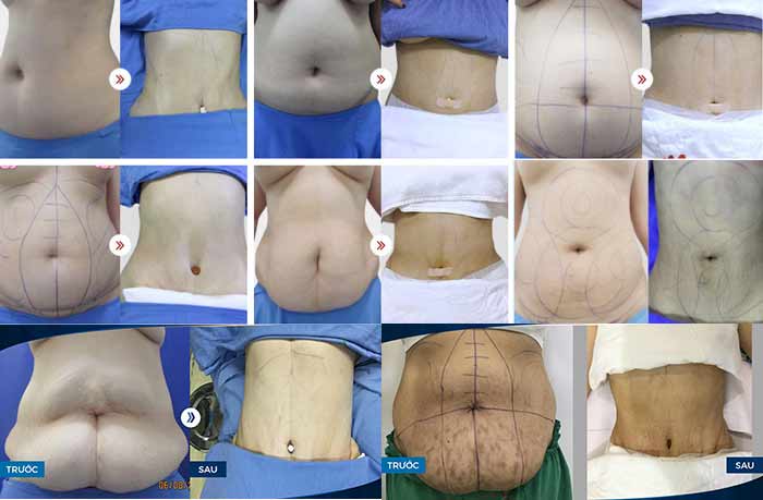 có nên hút mỡ bụng không