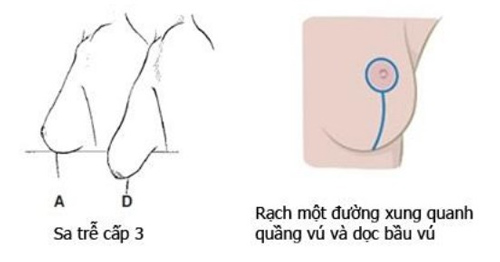 nâng ngực sa trễ không đặt túi