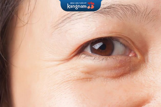 Đôi mắt già nua, hõm sâu, lão hóa nhiều cần được cải thiện bằng phương pháp bơm mỡ vào hốc mắt 