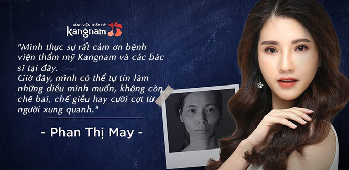 Chị Phan Thị May sau khi chọn Kangnam là nơi độn cằm HCM cho bản thân