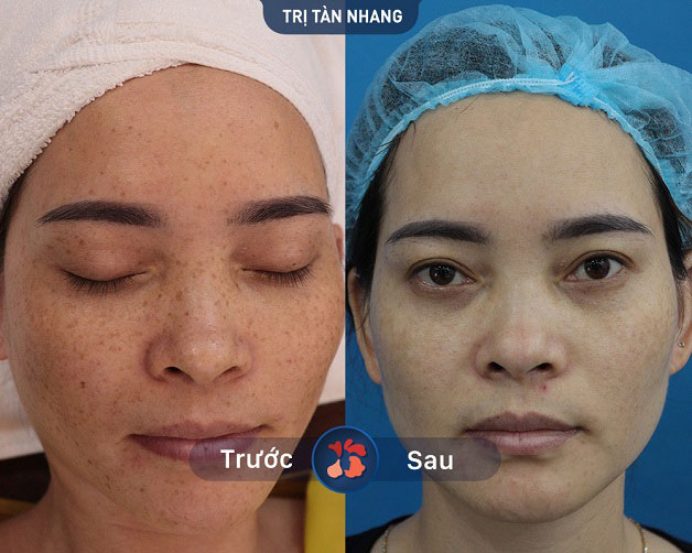 Sạch tàn nhang lâu năm sau khi điều trị bằng Laser Picosure