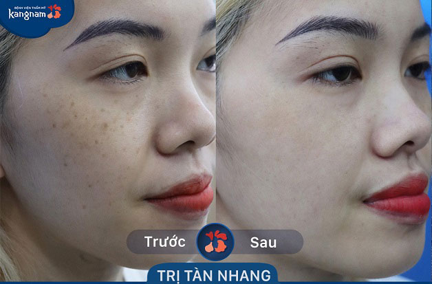 Tàn nhang hết nhanh chóng chỉ sau 2-3 liệu trình điều trị