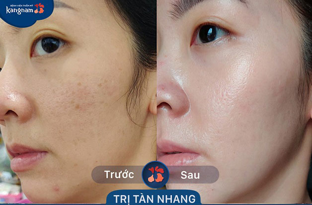 Trị tàn nhang bằng Laser Toning phù hợp với kinh tế của nhiều khách hàng